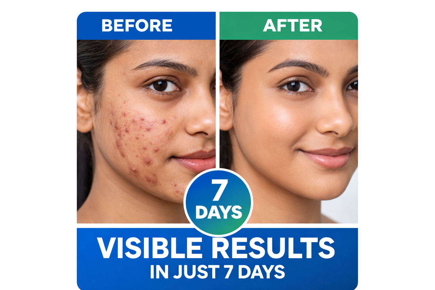 🌿 Clear Skin in 7 Days | Acne Removal Gel